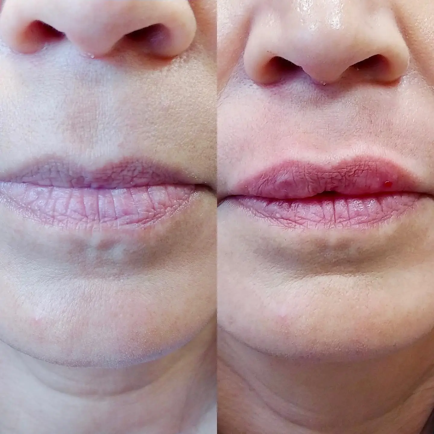 Before and after Restylane lip augmentation showing fuller, more defined lips in Fort Lee, NJ